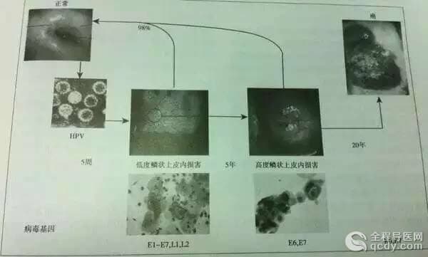 等了10年！宮頸癌疫苗終于要在內(nèi)地上市，就在明年年初！轉(zhuǎn)給身邊所有的女性！