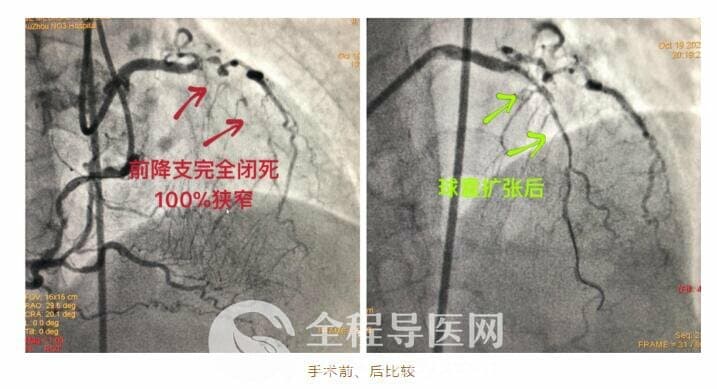 徐州市三院心臟團(tuán)隊(duì)于長(zhǎng)城心臟病學(xué)大會(huì)CTO論壇直播超高難度冠心病介入手術(shù)